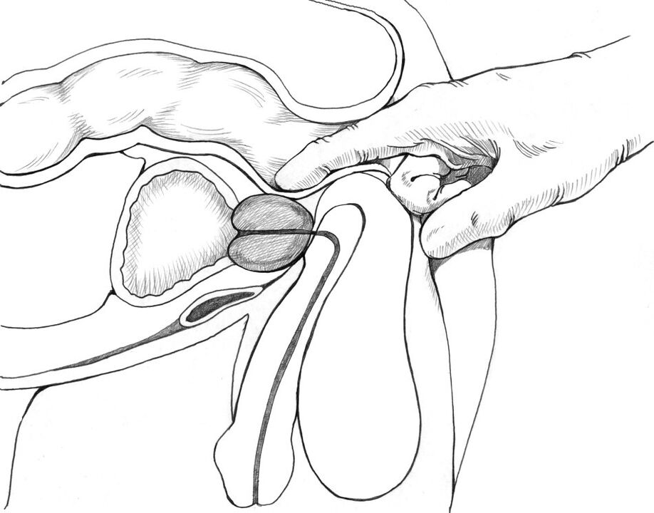 Le massage de la prostate est inclus dans l'ensemble des méthodes de traitement de la prostatite